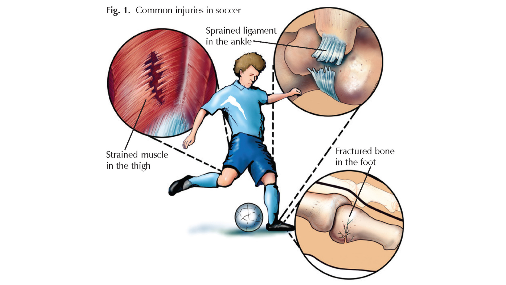 types of ankle injuries from soccer